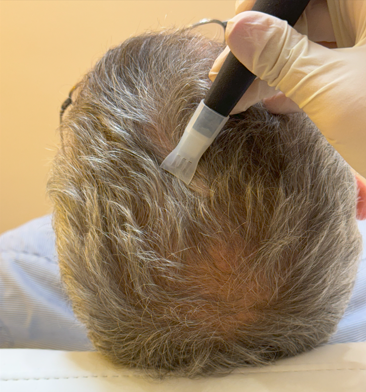 REYU : rajeunissement et régénération naturelle des cheveux