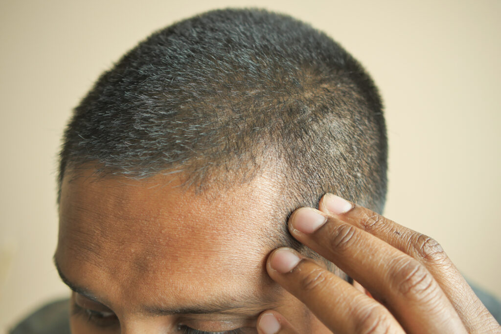 traitement chute de cheveux