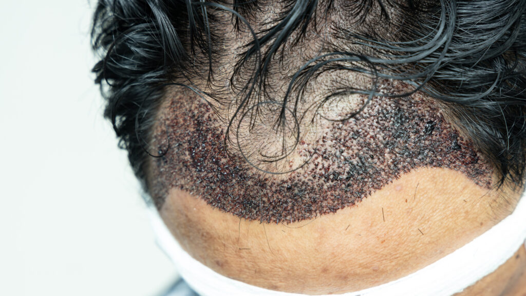 Questions les plus fréquentes sur les contraintes après une greffe de cheveux