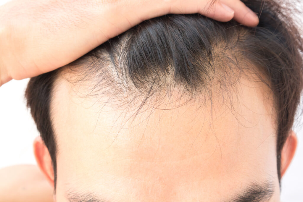 Perte de cheveux traitement pour homme